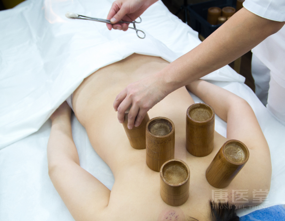 Cupping 拔罐
