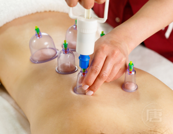 Cupping 拔罐